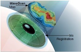 lasik eye surgery diagram