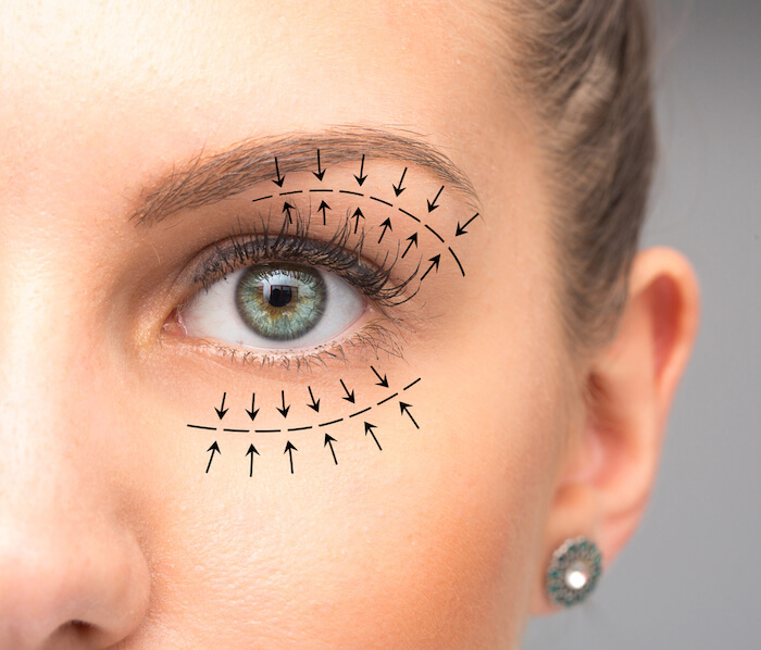 Woman's eye with illustrated arrows showing effects of plastic surgery