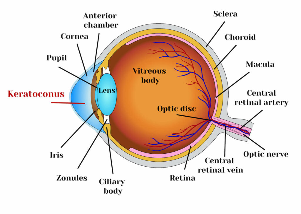 Keratoconus. Dystrophic disease of the cornea.