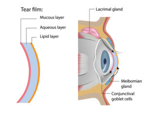 diagram of dry eye syndrome