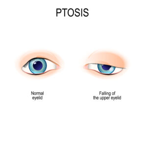diagram of ptosis