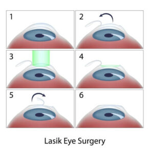 lasik diagram